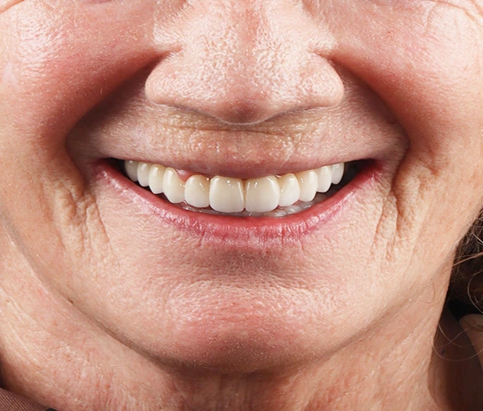 After Dental Implants