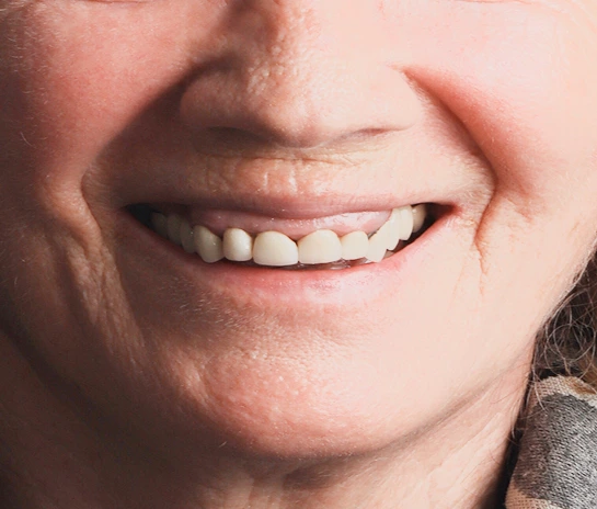 Before Dental Implants